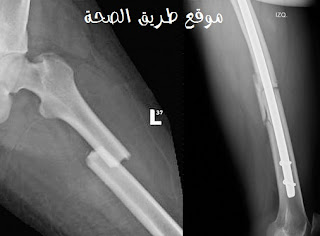 توضح الصورة اليسرى وجود كسر فى عظمة الفخذ أما الصورة اليمنى فتوضح علاج الكسر باستخدام الشرائح المعدنية