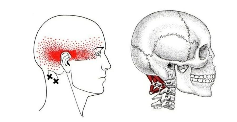 dolor cervical y dolor de cabeza - sub occipital - semiespinoso superior de la cabeza - mc spa