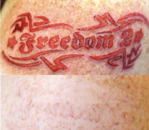 Little Effects of Tattoo Removal. When it comes to tattoos that are removed 