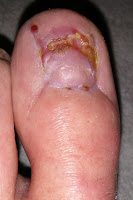 Big Toenail Removal - Left Foot - 10 Weeks & 4 Days