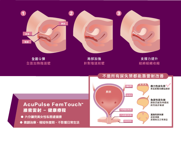 femtouch維密雷射鬆弛漏尿頻尿私密處老化更年期