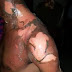  Man was bath with hot water by his ex after he ended their relationship (graphic pics)