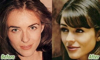 celebrity plastic surgery