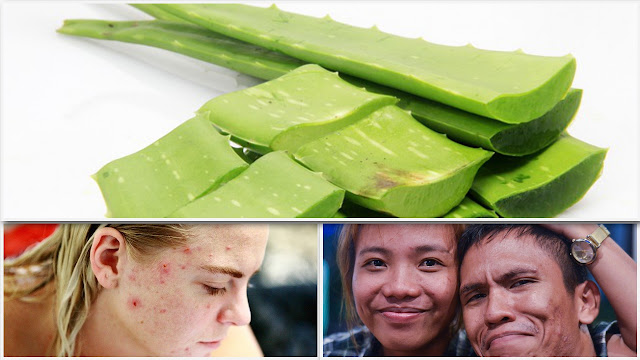 Cara Menghilangkan Jerawat Dengan Lidah Buaya Dengan Mudah