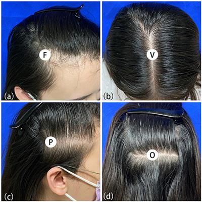 WHAT IS HAIR LOSS?  WHAT DIFFERENCE BETWEEN ALOPECEA AND HAIR LOSS? TYPES , CAUSES, WHAT IS MAIN SYMPTOMS  OF HAIR LOSS IN FEMALES? FRONT HAIR LOSS IN FEMALES, DIET, TREATMENT