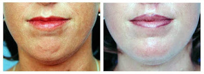 Chin Augmentation Pictures