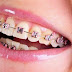 Nhổ răng khi chỉnh nha có tác hại gì đến sức khỏe không?