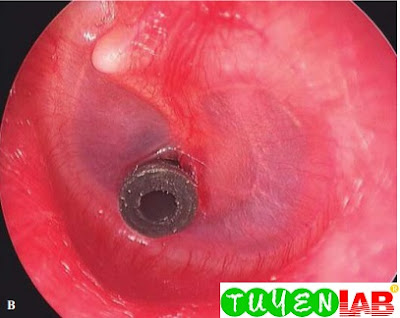 A fluoroplastic polyethylene (PE) tube is placed in the anterior-inferior quadrant of the TM of a 9-yearold girl with  recurrent acute otitis media