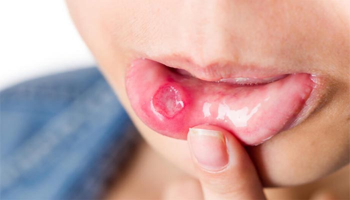 mouth-cancer-signs-and-symptoms