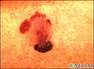 Tattoos Causes  Melanoma Cancer || Tattoos, Moles, and Melanoma