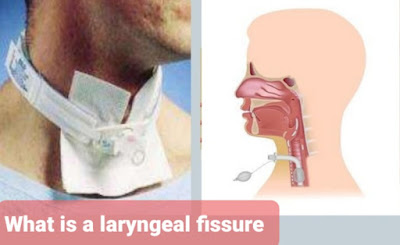 What is a laryngeal fissure   ما هو الشق الحنجري
