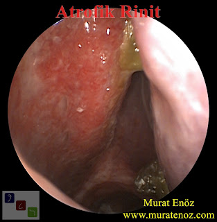 Atrofik rinitte lazer tedavisi - Atrofik rinit tedavisi - Atroifk rinit tedavisi için lazer - Ozena