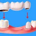 Phục hình răng cố định có những loại nào?