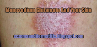 Monosodium Glutamate And Your Skin