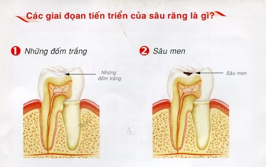 Nhổ răng sâu không đau an Toàn không biến chứng