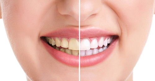 Tẩy trắng răng cho bạn hàm răng trắng sáng lên tới 2 – 3 tone màu