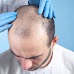 Essential Things You Should Be Aware Of Before Availing Of India Best Hair Transplant Services