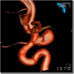 12 YRS POST CLIPPING RECURRENCE 3D