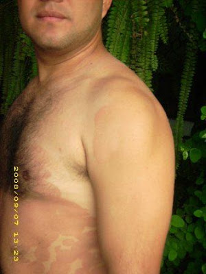 Cuerpo con Psoriasis