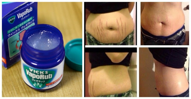 Heboh! Vicks Vaporub Cepat Atasi Stretch Marks Usai Melahirkan Cukup Sekali Oles Hangsung Hilang Tak Berbekas !