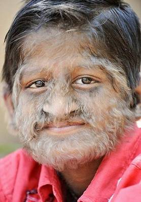 Porphyria-The Vampira Disease Porphyria-The Vampira Disease