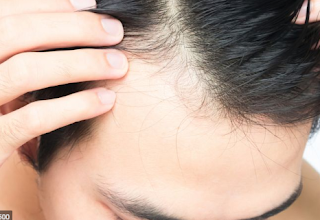 Sembuhkan Kebotakan Anda & Alopecia dengan Cara Alami (Herbal Cina)