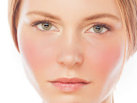 Rosacea: Gejala, Penyebab, Diagnosis, dan Pengobatan