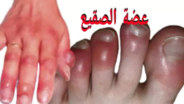 الخصر أو التثليج أو لسعة الصقيع