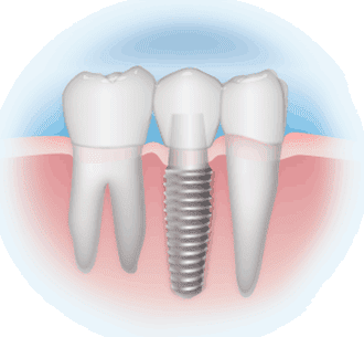 Trồng răng Implant uy tín nhất tại Sài Gòn