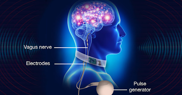 Vagus Nerve Stimulators Market