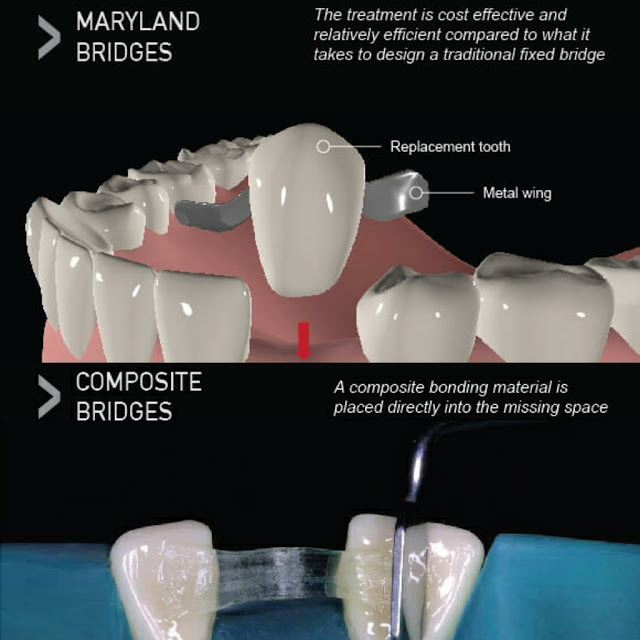 Lepas retainer, composite bridge pula