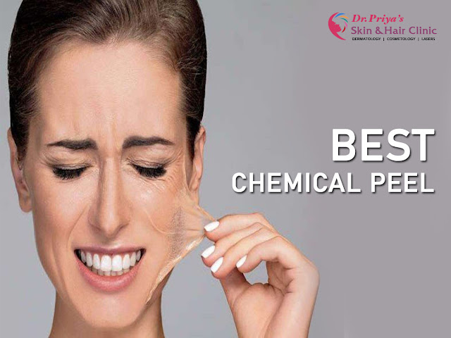 Best Chemical Peel In Bangalore