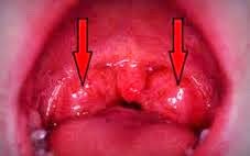 Obat Tradisional Amandel Bengkak