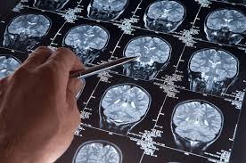 Falta de diagnósticos para Alzheimer preocupa especialistas
