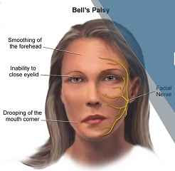 bell's palsy