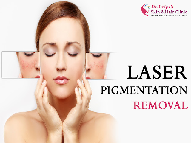 Best Laser Pigmentation Removal In Bangalore