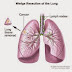 A summary involving Lung Cancer