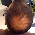 Type of alopecia hair loss