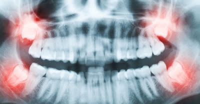 Giải thích tại sao phải nhổ răng khôn khi niềng răng-1