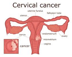 Understanding Cervical Cancer: Causes, Symptoms, Diagnosis, Treatment, and Prevention