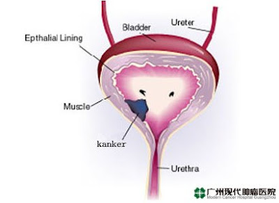 Bagaimana membedakan stadium dari kanker kandung kemih
