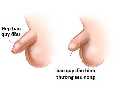 hep-bao-quy-dau-la-gi