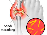 Obat Generik Kaki Bengkak Karena Asam Urat