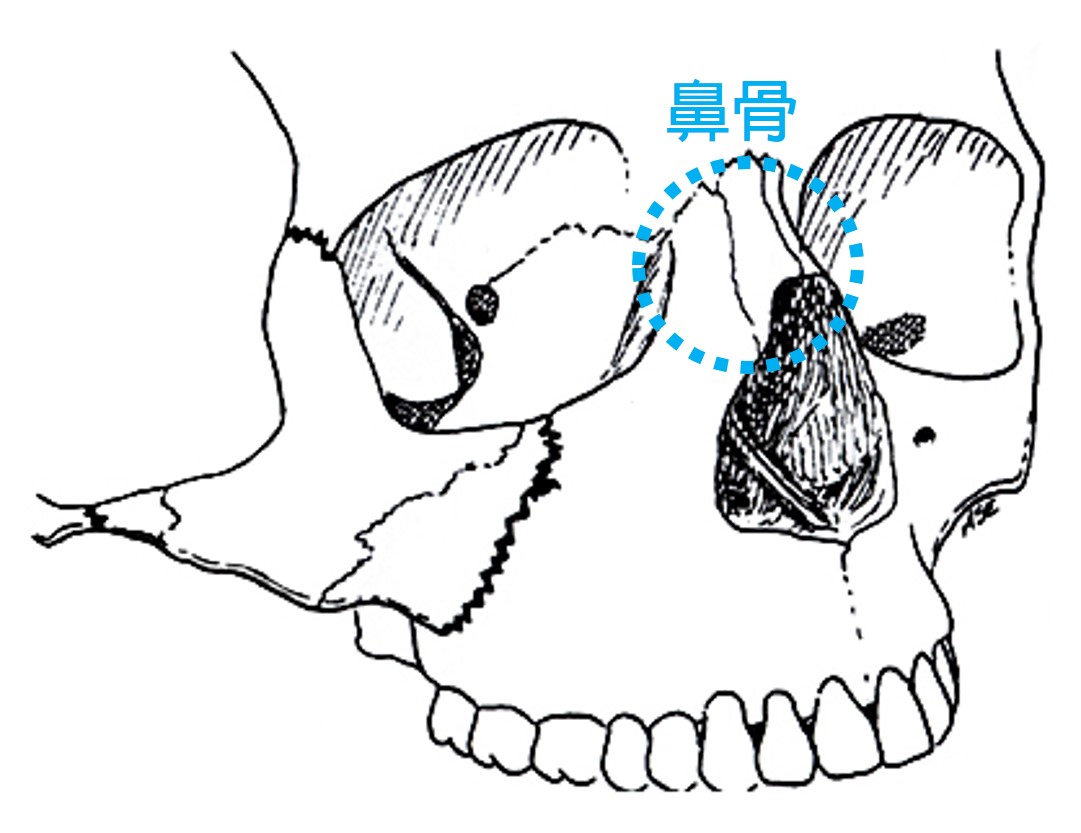 李宜展 耳鼻喉專科醫師 鼻骨骨折了怎麼辦