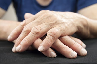 Causes of Psoriatic Arthritis