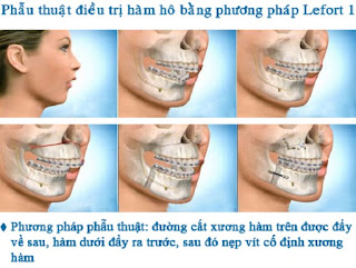 Phẫu thuật hàm hô móm là thế nào-2