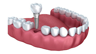 dental implants