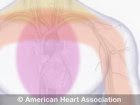 Gejala dan Diagnosis Serangan Jantung