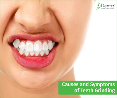 Teeth Grinding Treatments at Dentzz Dental