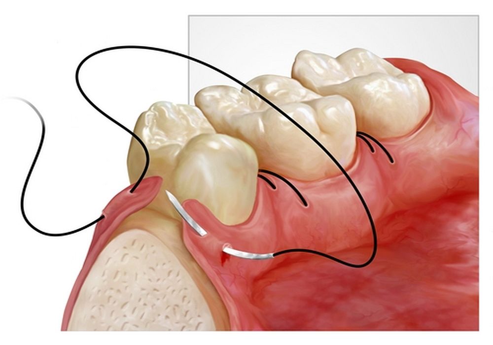 Sutura Cirugia Bucal